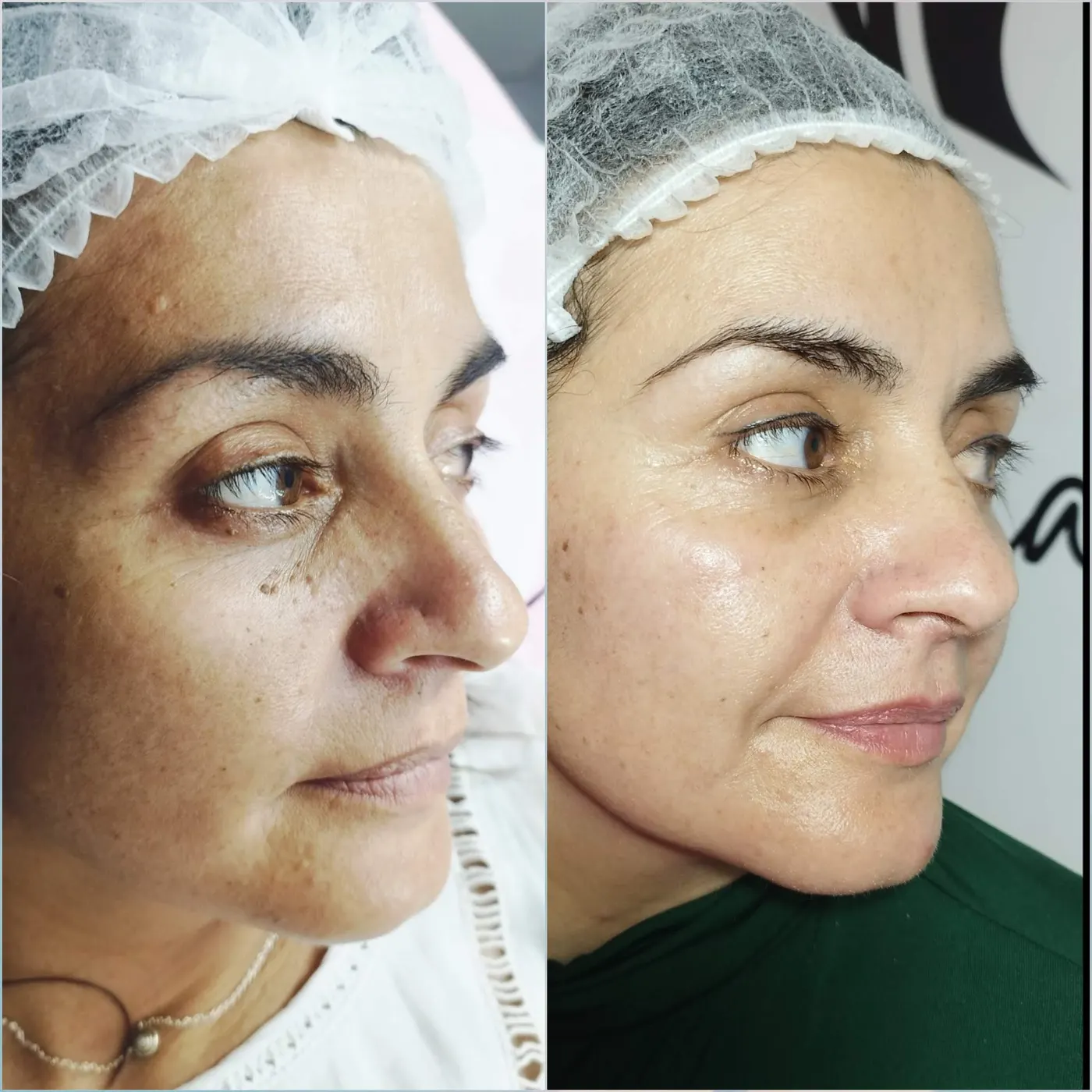 Resultado de tratamiento facial en Danalya Estética